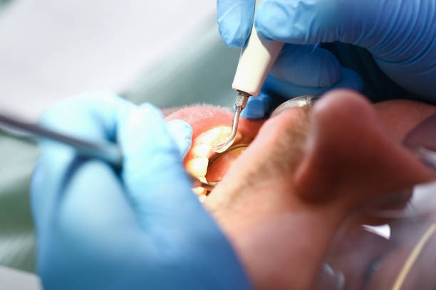 Best Emergency Root Canal Treatment in Metter, GA